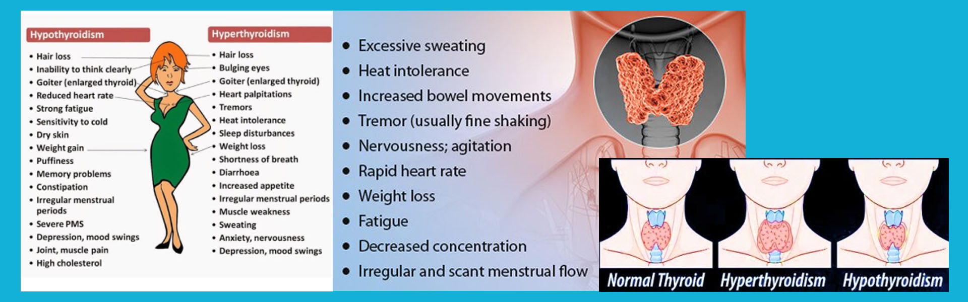 থাইরয়ডিজম, Thyroidism, general