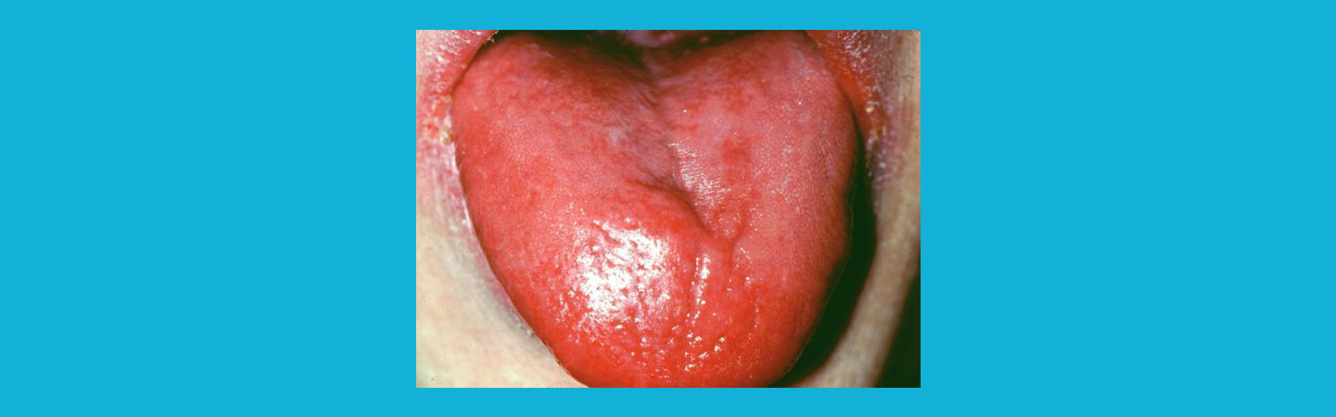 জিহ্বা প্রদাহ , Glossitis (Tounge Infection)