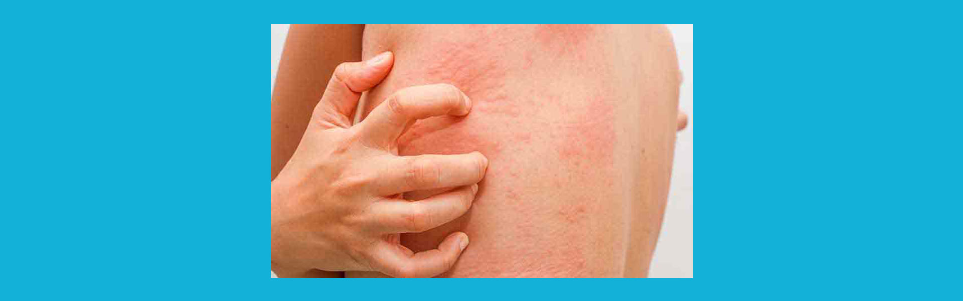 পাঁচড়া, Scabies, পাচরা, পাচড়া,