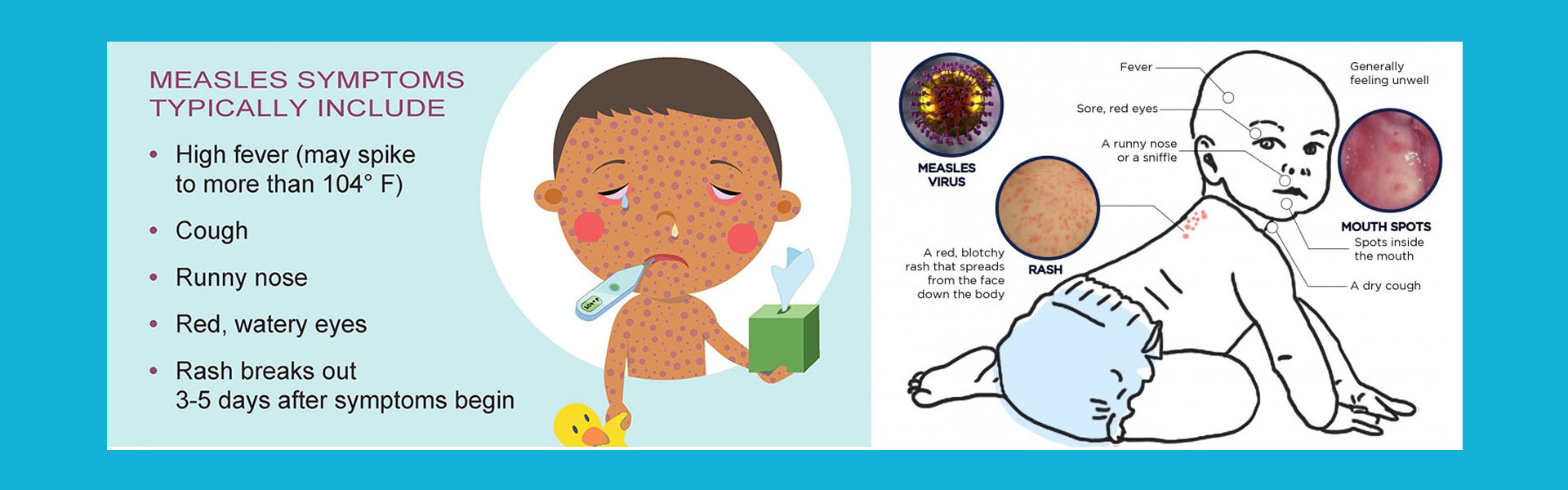 জ্বর - হাম জ্বর, Fever - Measles Fever, Rubeola