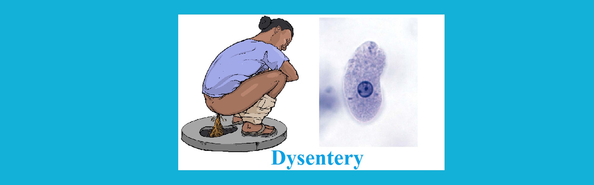 আমাশয়, Dysentery