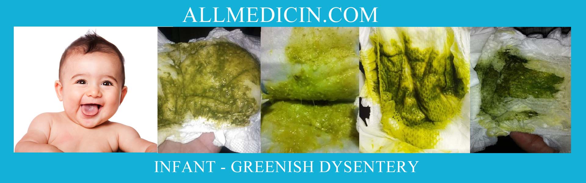 আমাশয় - শিশুর সবুজ আমাশয়, Dysentery - Infant Greenish Dysentery, digestive, babycare