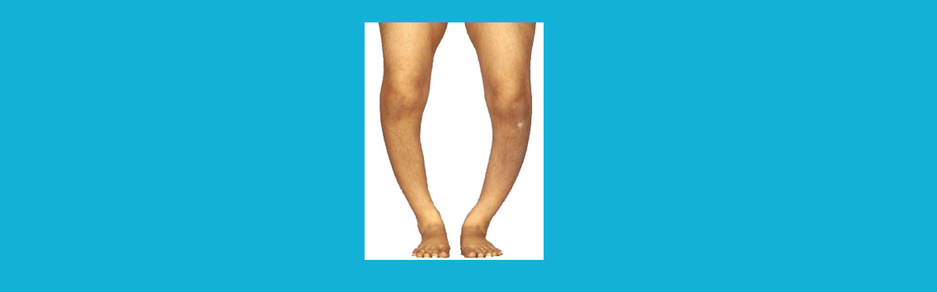 রিকেটস, Rickets 